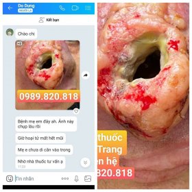 vết thương thường gặp trong tình trạng rất nguy hiểm cần kịp thời điều trị