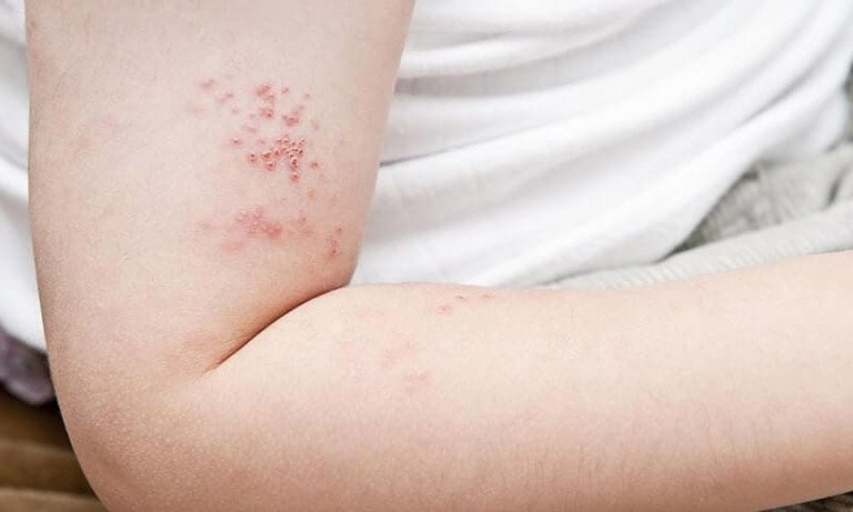 PHÂN BIỆT GIỮA ZONA, BỆNH VIÊM DA DO CÔN TRÙNG VÀ HERPES DA