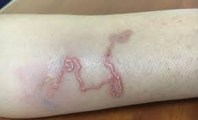 BỆNH ẤU TRÙNG DI CHUYỂN Ở DA