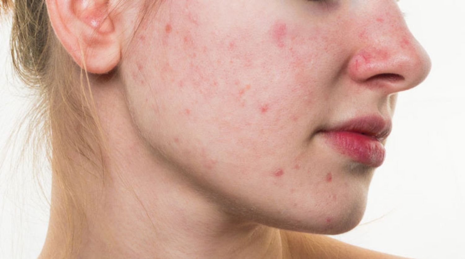 ĐIỀU TRỊ TRỨNG CÁ ĐỎ