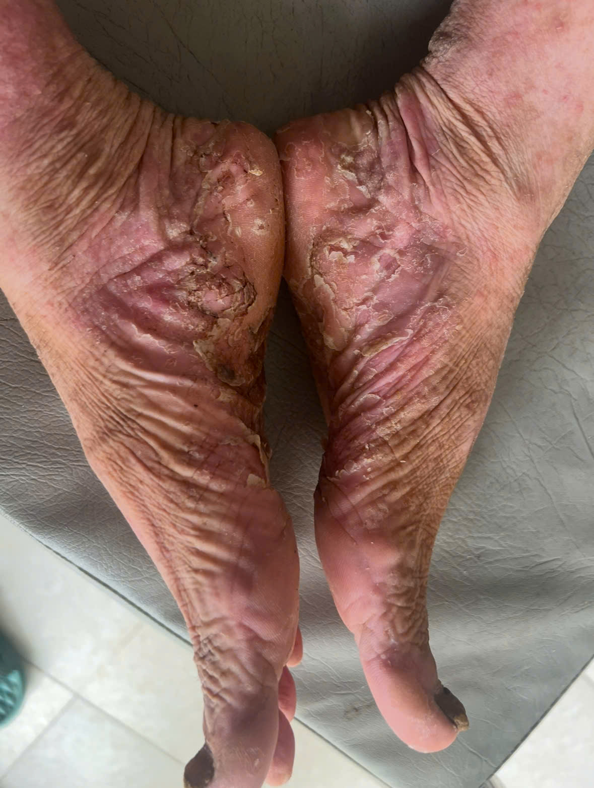 MÙA HÈ NẮNG NÓNG: LÀM SAO ĐỂ VIÊM DA CƠ ĐỊA KHÔNG "BÙNG PHÁT"?